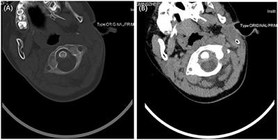 Grisel's syndrome associated with mumps: A case report